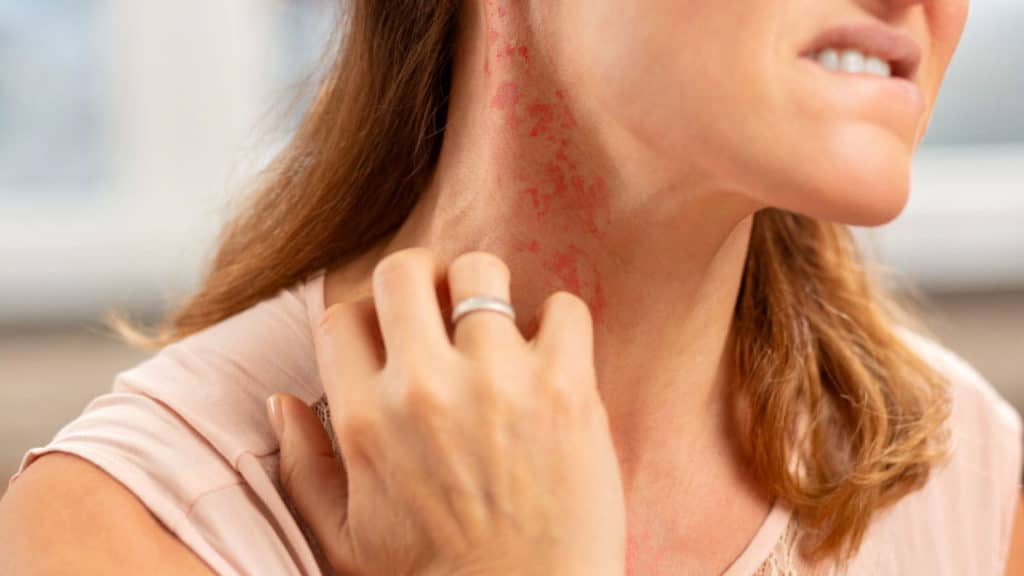 A person scratching their neck, showing red, irritated skin possibly due to a rash or allergic reaction. They wear a light pink shirt and have shoulder-length brown hair.