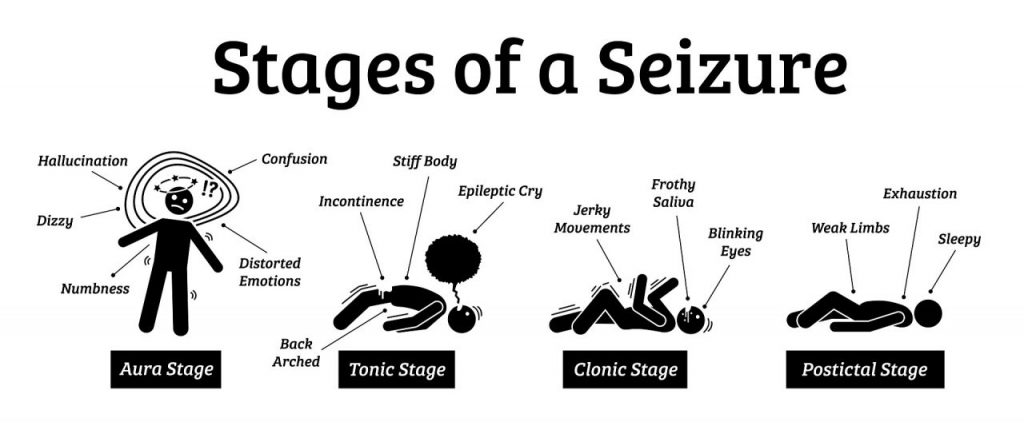 Illustration of seizure stages: Aura Stage shows symptoms like hallucination and confusion. Tonic Stage includes a stiff body and incontinence. Clonic Stage features jerky movements and frothy saliva. Postictal Stage involves exhaustion and weak limbs.