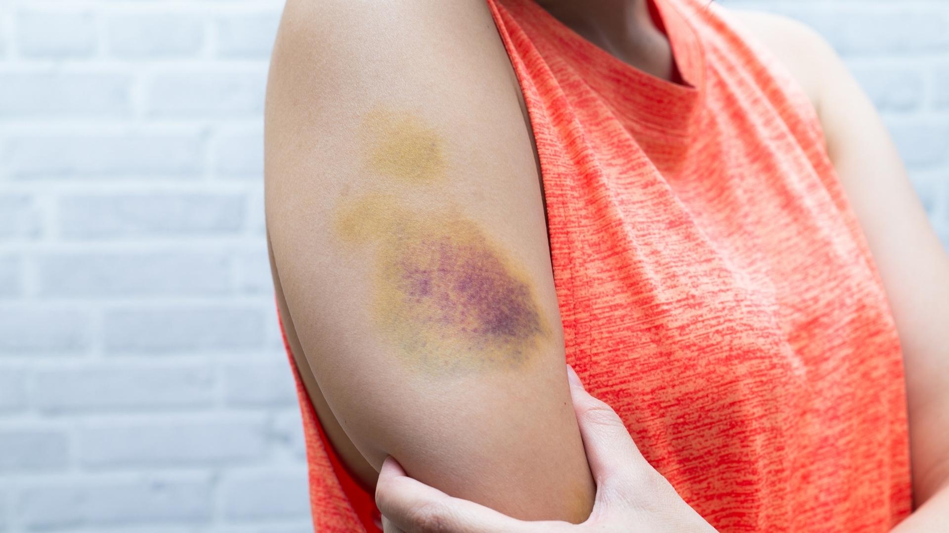 A person wearing a sleeveless orange shirt shows a large bruise on their upper arm. The bruise appears to be at different stages of healing, with discoloration ranging from yellow to deep purple.